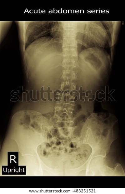 Acute Abdomen Series Stock Photo 483251521 Shutterstock