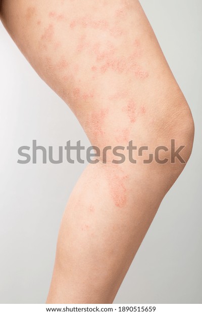 Acute atopic dermatitis on the legs behind the\
knees of a child is a dermatological disease of the skin. Large,\
red, inflamed, scaly rash on the legs. Legs of a teenager with\
severe atopic eczema.
