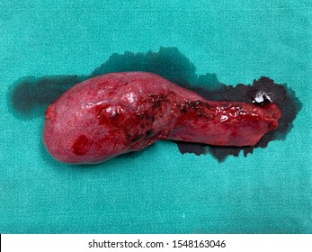 Acute Cholecystitis S/P Cholecystectomy, Gallbladder