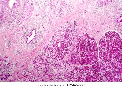 Acute Hemorrhagic Pancreatitis, Light Micrograph, Hematoxylin And Eosin Staining