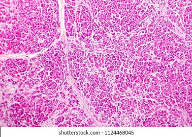 Acute hemorrhagic pancreatitis, light micrograph, hematoxylin and eosin staining