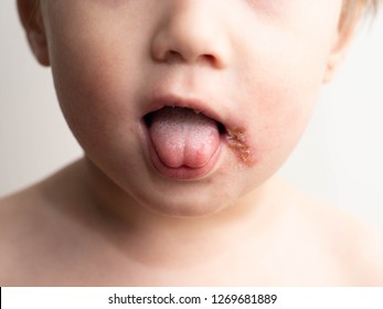 Stomatitis Images Photos Et Images Vectorielles De Stock Shutterstock