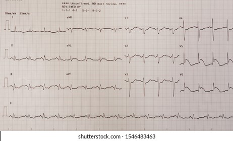 Acute Lateral Wall ST Elevation Myocardial Infarction.