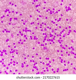 Acute Leukemia, Peripheral Blood Smear Show Most Of Cell Are Blast Cell With Abundant Cytoplasm, Variable Chromatin And Multiple Nucleoli Present.