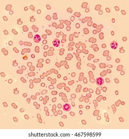 Acute Lymphoblastic Leukemia          