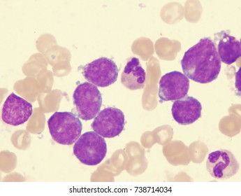 Acute Lymphoblastic Leukemia (ALL), L1 Subtype