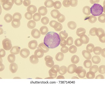 Acute Lymphoblastic Leukemia (ALL), T-cell Subtype