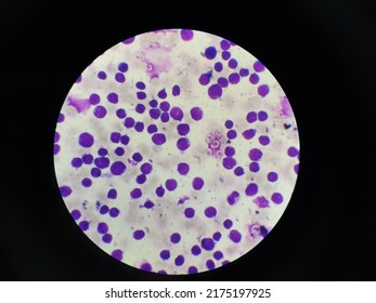 Acute Lymphoblastic Leukemia Blood Smear