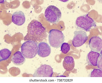 Acute Myelogenous Leukemia Aml M4e Eosinophilic Stock Photo (Edit Now ...