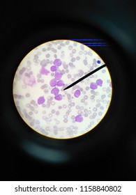 Acute Myeloid Leukemia