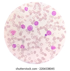 Acute Myeloid Leukemia (AML) Cells Analysed By Light Microscope.