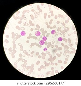 Acute Myeloid Leukemia (AML) Cells Analysed By Light Microscope.