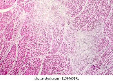 Acute myocardial infarction, histology of heart tissue, light micrograph. Area of infarct is paler than the relatively viable area of heart muscle