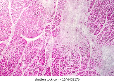 81 Myocardial Necrosis Images, Stock Photos & Vectors | Shutterstock