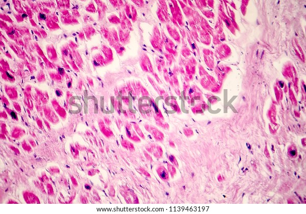 Acute Myocardial Infarction Histology Heart Tissue Stock Photo ...