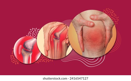 Acute pain in a knee joint, close-up. Color image, isolated on a pastel background. Pain area of red color, Senior woman holding the knee with pain. Collage. - Powered by Shutterstock