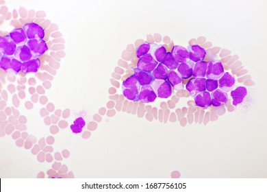 Acute Lymphoblastic Leukemia Images Stock Photos Vectors Shutterstock
