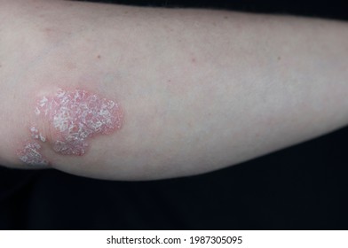 Single psoriasis spot