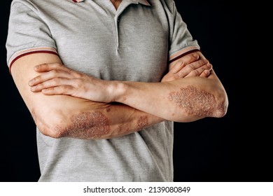 Acute Psoriasis On The Elbows Is An Autoimmune Incurable Dermatological Skin Disease. A Large Red, Inflamed, Flaky Rash On The Elbows. Joints Affected By Psoriatic Arthritis.