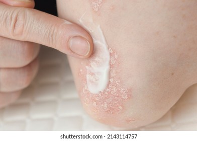 Acute Psoriasis On The Elbows Is An Autoimmune Incurable Dermatological Skin Disease. Large Red, Inflamed, Flaky Rash On The Elbows. Joints Affected By Psoriatic Arthritis