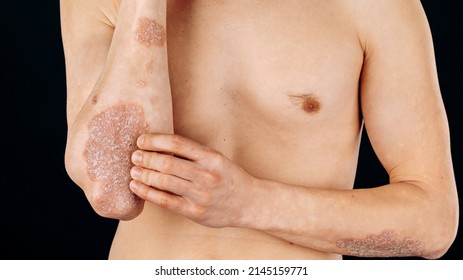 Acute Psoriasis On The Elbows Is An Autoimmune Incurable Dermatological Skin Disease. A Large Red, Inflamed, Flaky Rash On The Elbows. Joints Affected By Psoriatic Arthritis.