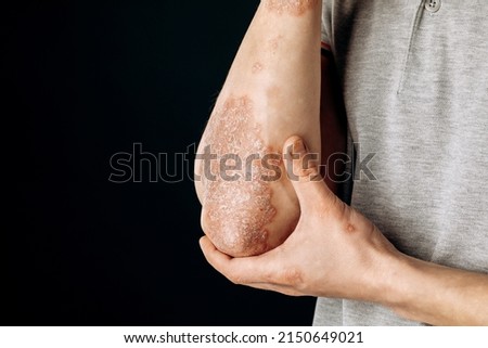 Acute psoriasis on the elbows is an autoimmune incurable dermatological skin disease. A large red, inflamed, flaky rash on the elbows. Joints affected by psoriatic arthritis.