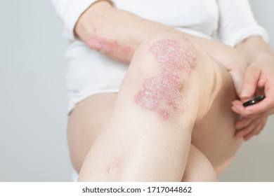 Acute psoriasis on the knees ,body ,elbows is an autoimmune incurable dermatological skin disease. Large red, inflamed, flaky rash on the knees. Joints affected by psoriatic arthritis.