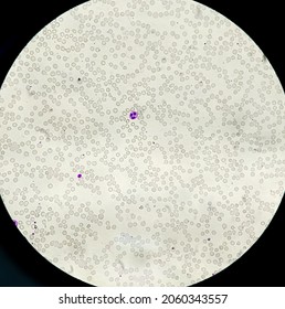 Acute thrombocytopenia and leucocytopenia. Close up Micrograph of dengue virus fever patient at medical laboratory.