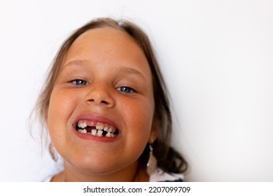 Adorable Girl With Open Toothless Mouth With Temporary Milk Spacing Crowding Teeth In White Isolated Studio. Orthodontic Practice, Dental Work With Cross Bite And Overjet. Caries Decay. Copy Space