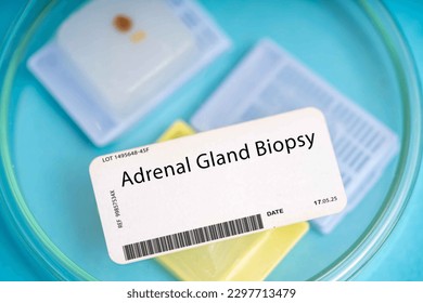 Adrenal gland biopsy. A small piece of adrenal gland tissue to evaluate for conditions such as adrenal tumors or hyperplasia.