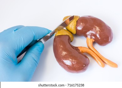 Adrenal gland surgery concept photo. 3D anatomical shape of adrenal gland and kidneys next to  surgeon hand in blue glove holding scalpel. Surgery operation in cancer, tumor, pheochromocytoma, adenoma