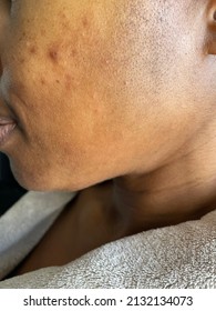 Adult Acne Scars On The Cheek Of A Black Person