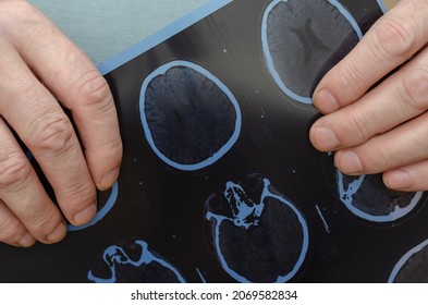 Adult Male Holding A CT Scan Of The Brain. Examination Of A Patient In The Radiology Department At A Hospital. Cranial Trauma, Concussion. Health Insurance. Selective Focus.