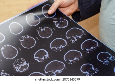 Adult Male Holding A CT Scan Of The Brain. Examination Of A Patient In The Radiology Department At A Hospital. Traffic Accident, Concussion. Selective Focus.