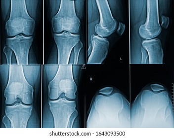 Adult Male Knees X-ray Image With Different Angles. Medical And Human Anatomy Imagery.