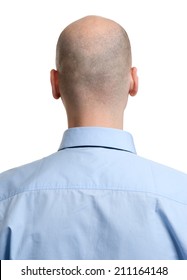 adult man bald head rear view. Human hair loss