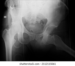 Adult Man Pelvis. Hip Dislocation In The Obturator Foramen 