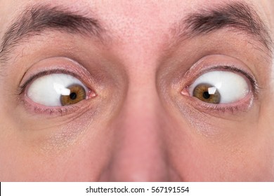 Adult Man Is Squinting, Closeup, Concept Strabismus