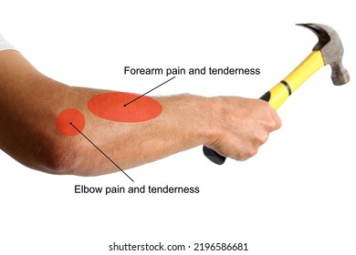 Adult Man's Arm Holding Hammer Isolated On White, Showing Area Of Pain And Symptoms Of Injured. Overuse Injuries Of The Elbow Due To  The Repetitive Nature Or Work And Sporting Activities.