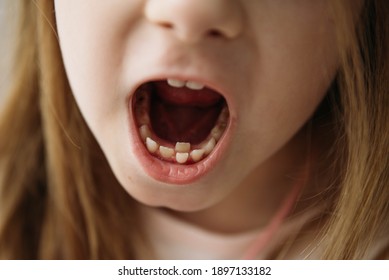 Adult Permanent Teeth Coming In Front Of The Child's Baby Teeth: Shark Teeth. Little Girl's Open Mouth.