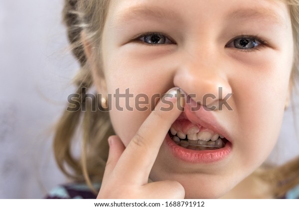 Adult Permanent Teeth Coming In Front Of The Child's Baby Teeth: Shark ...