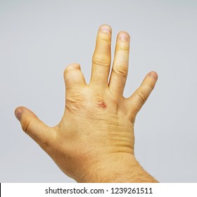 Missing Fingers Hd Stock Images Shutterstock