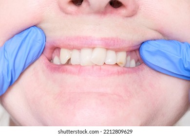 Adult Woman Teeth With Malocclusion Close Up, Orthodontic Problem And Preparing For Treatment, Crooked Teeth Before Installing Braces