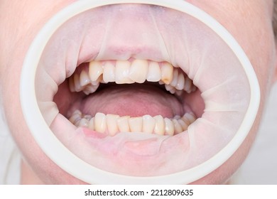 Adult Woman Teeth With Malocclusion Close Up, Orthodontic Problem And Preparing For Treatment, Crooked Teeth Before Installing Braces