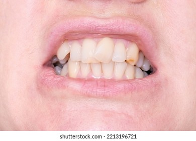 Adult Woman Teeth With Malocclusion Close Up, Orthodontic Problem And Preparing For Treatment, Crooked Teeth Before Installing Braces