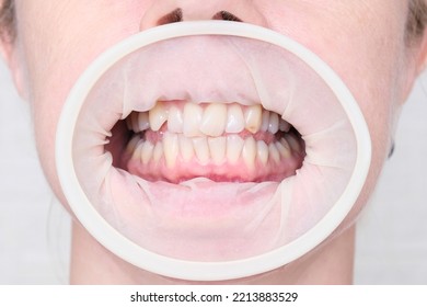 Adult Woman Teeth With Malocclusion Close Up, Orthodontic Problem And Preparing For Treatment, Crooked Teeth Before Installing Braces