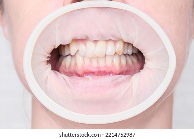 Adult Woman Teeth With Malocclusion Close Up, Orthodontic Problem And Preparing For Treatment, Crooked Teeth Before Installing Braces