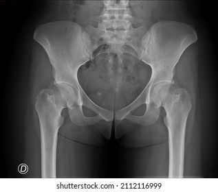 Adult Woman's Pelvis. Calcifications In The Urethral Pelvis 