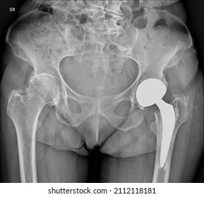 Adult Woman's Pelvis. Fracture Of The Right Femoral Head And Outcomes Of Left Hip Replacement 