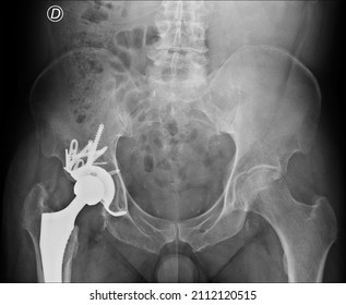 Adult Woman's Pelvis. Right Hip Prosthesis And Subsequent Reprise Operations 